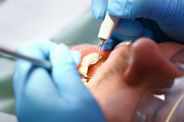 Best Emergency Treatment for Dental Infections or Abscesses in Rochelle, GA