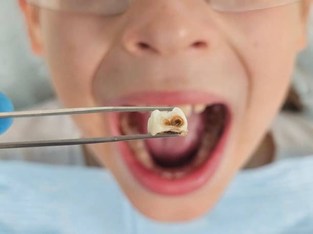 Best Emergency Wisdom Teeth Removal in Rochelle, GA
