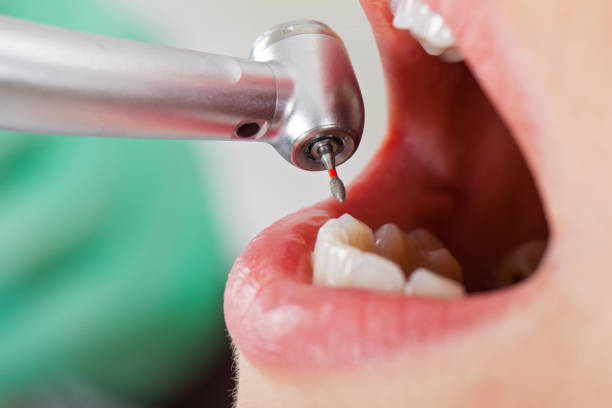 Best Emergency Gum Treatment in Rochelle, GA